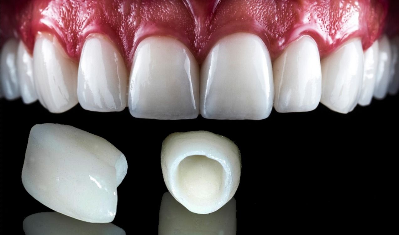 Porcelain vs. Zirconia: Choosing the Suitable Dental Crowns – BDnews55.com