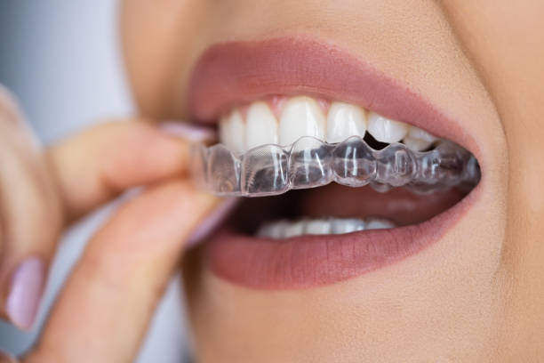 Invisalign for Pre-Teens: Why Early Alignment Can Prevent Bigger Issues Later - TheBlogyfi